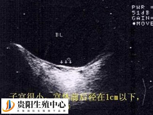 始基子宫B超声像有显示