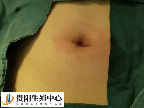 单孔腹腔镜手术的优势有哪些